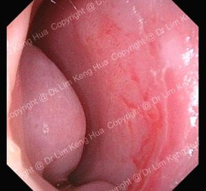 Endoscopic View of Anterior Septal Telangiectasia in a Child