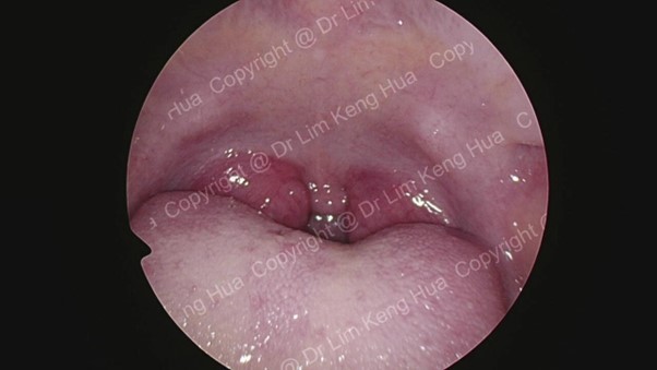 Endoscopic View of Bilateral Tonsillar Hypertrophy (“Kissing Tonsils”)
