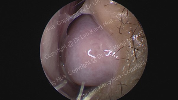 Endoscopic View of Pale, Hypertrophied Turbinates in Chronic Allergic Rhinitis
