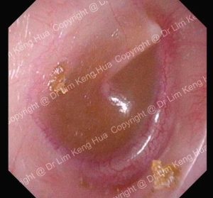Otoscopy Image Showing Middle Ear Effusion