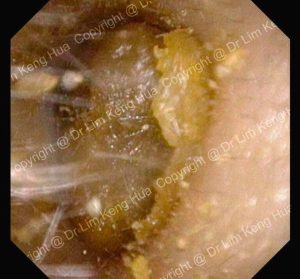 Otoscopy Showing Total Ear Canal Obstruction by Earwax