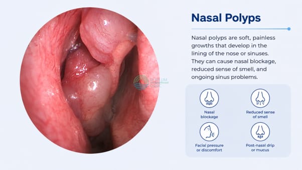 How Are Nasal Polyps Diagnosed